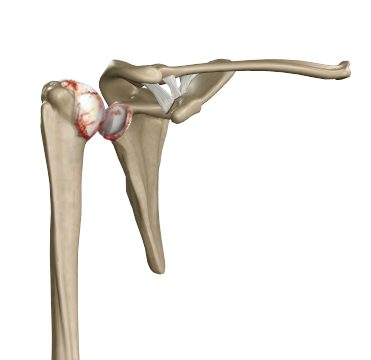 Shoulder Joint Arthritis